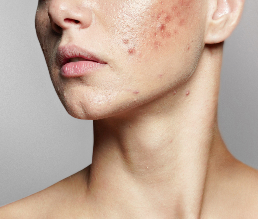 Acne-Skin-1