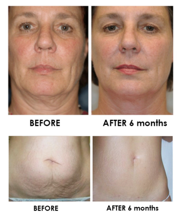 HIFU before after