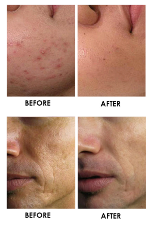 RF micro needling before and after