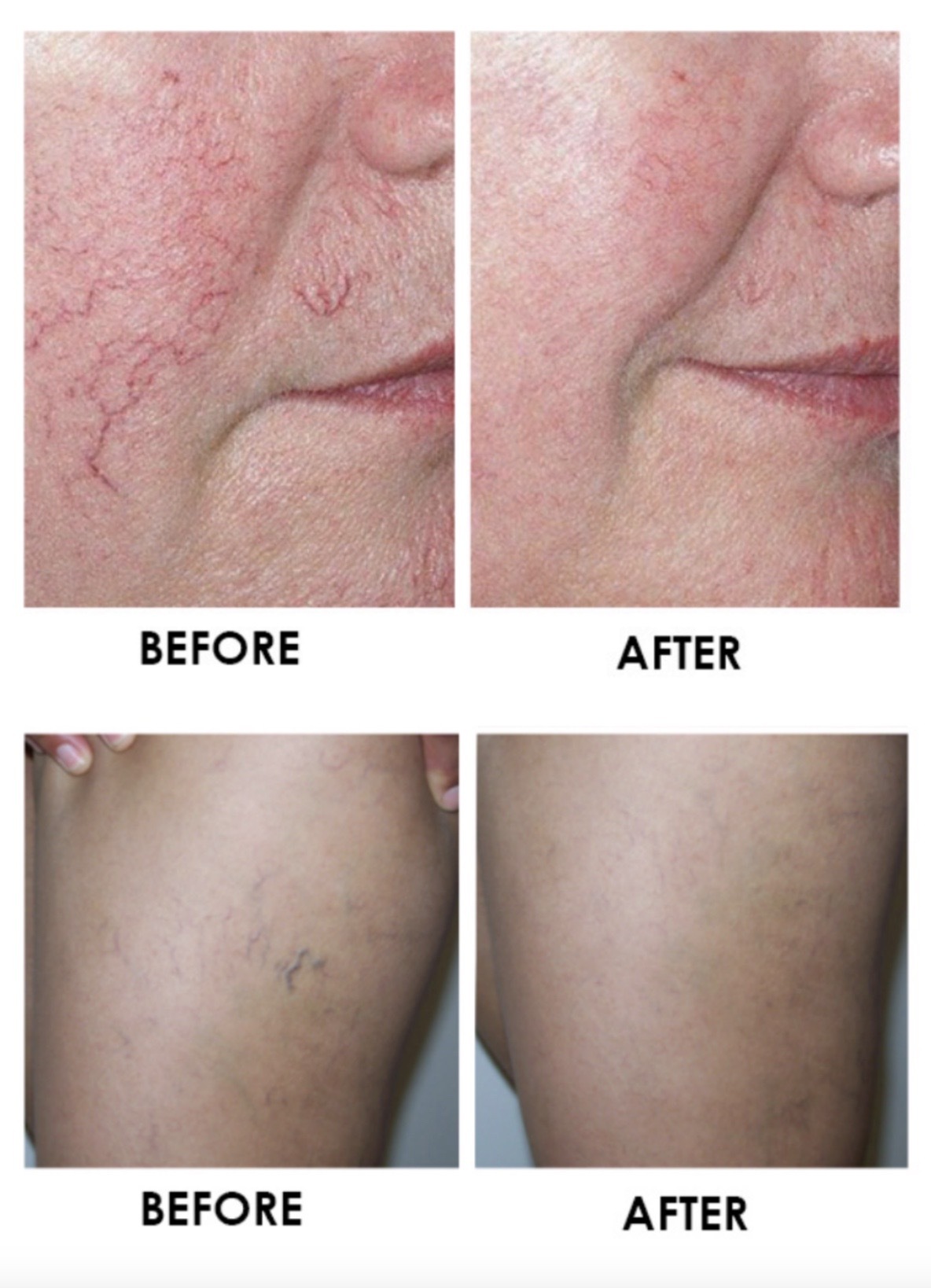 Thread Veins Removal - The Laser Clinic Group